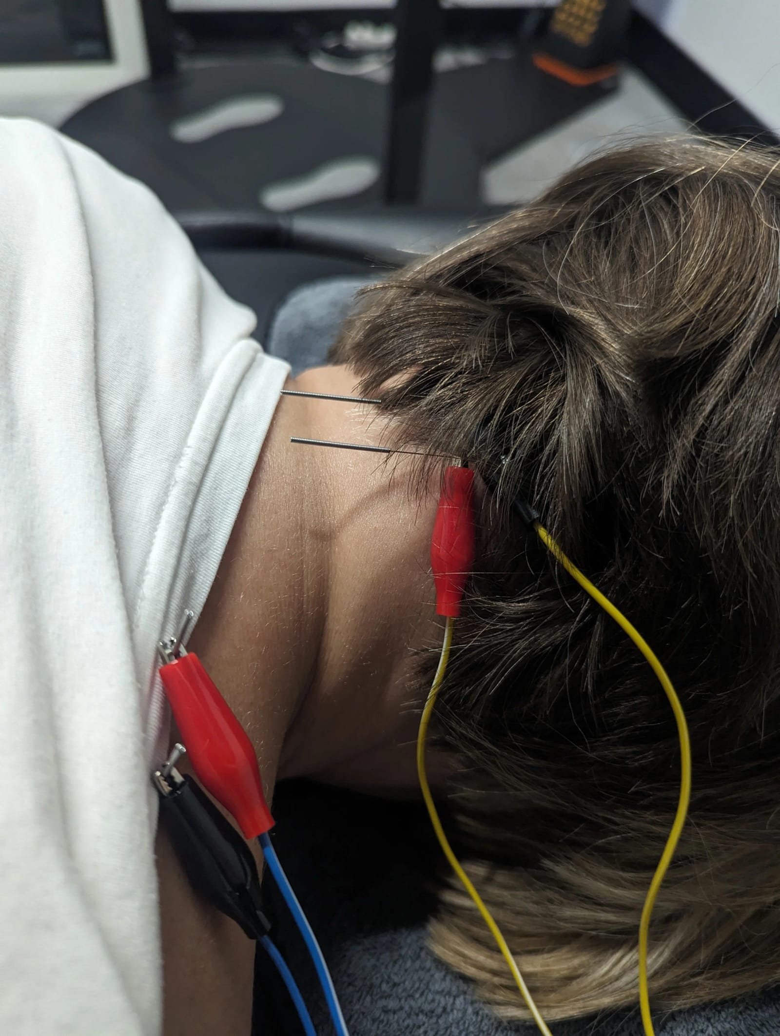 Needle Little Help? Overcoming Fear to Benefit from Dry Needling
